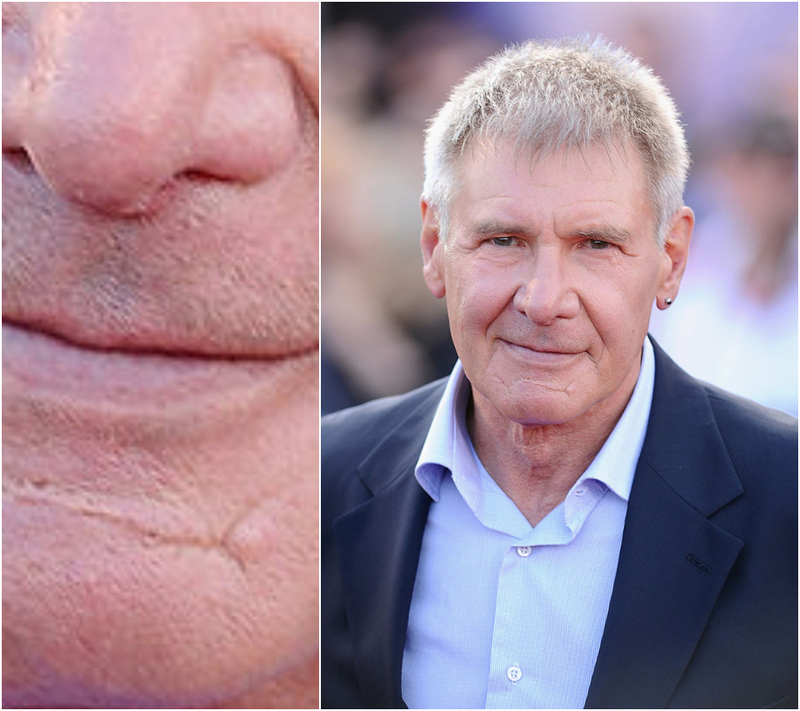 Chin Scar | Getty Images Photo by Ian Gavan