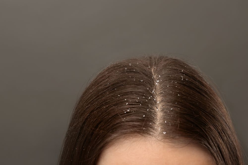 Relieve Dandruff | New Africa/Shutterstock