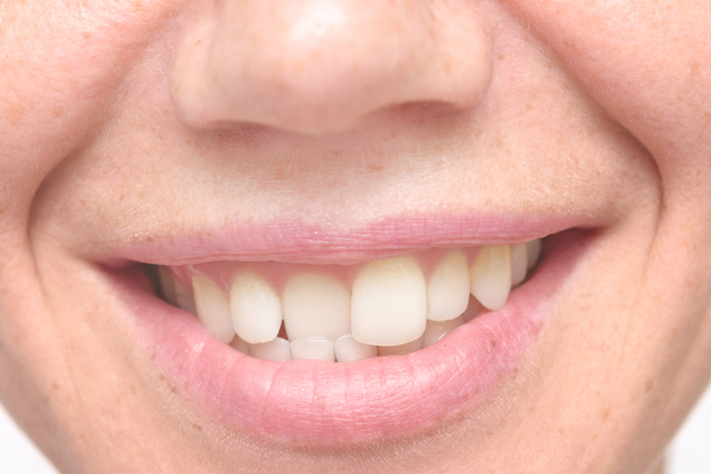 Dientes torcidos | Getty Images Photo by RusN