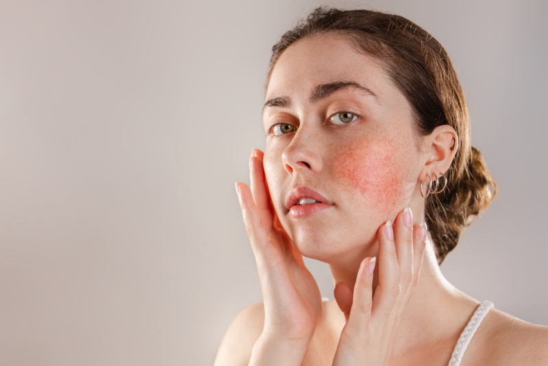 Relieve Rosacea | Shutterstock Photo by STEKLO