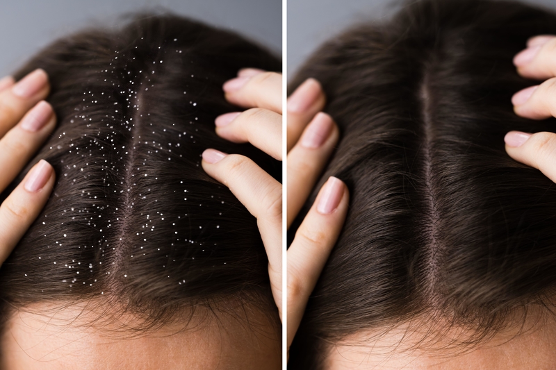 Reduce the Impact of Dandruff | Alamy Stock Photo