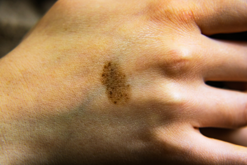 The Birthmark on Holly’s Hand | Shutterstock