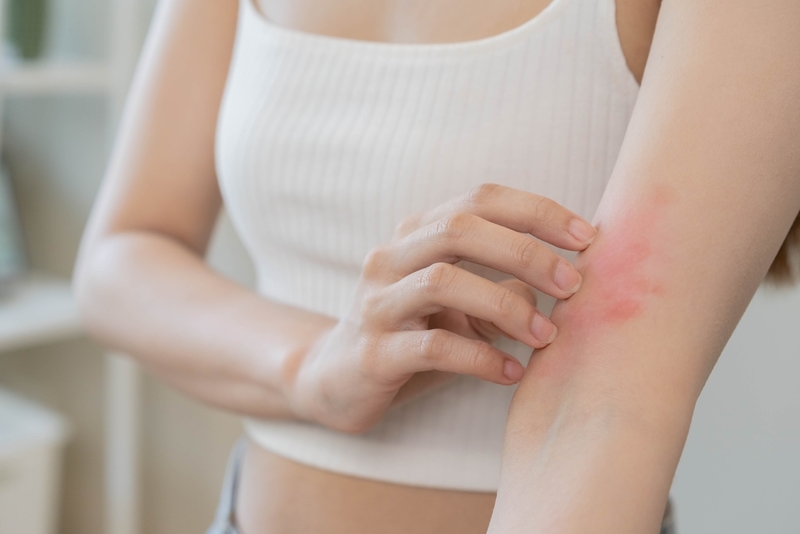 Itching Balm | Shutterstock