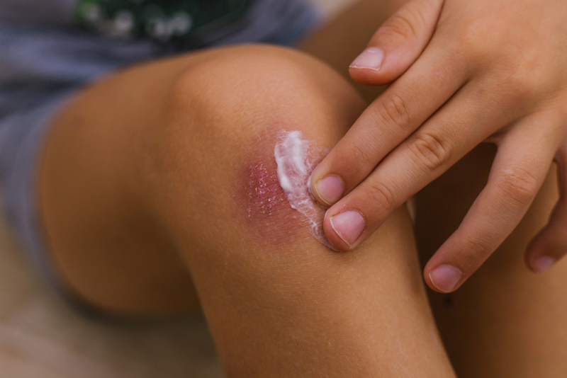 Help Heal Cuts, Scrapes, and Burns | Shutterstock